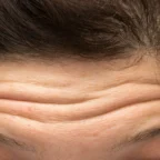 Rugas e linhas de expressão na testa feminina