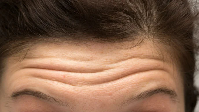 Rugas e linhas de expressão na testa feminina